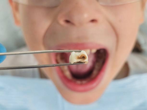 Best Knocked-Out Tooth Emergency  in Massillon, OH